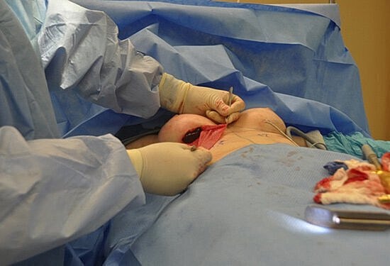 Surgical procedure on a patient in operating room.
