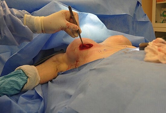 Surgical procedure on human chest under anesthesia.