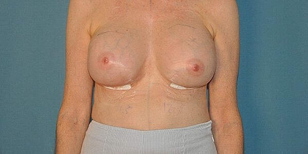 Post-surgery breast reconstruction before procedure.