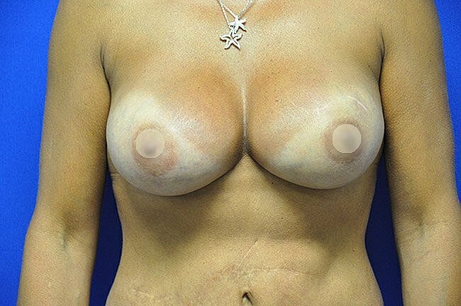Female torso with visible scars and necklace.