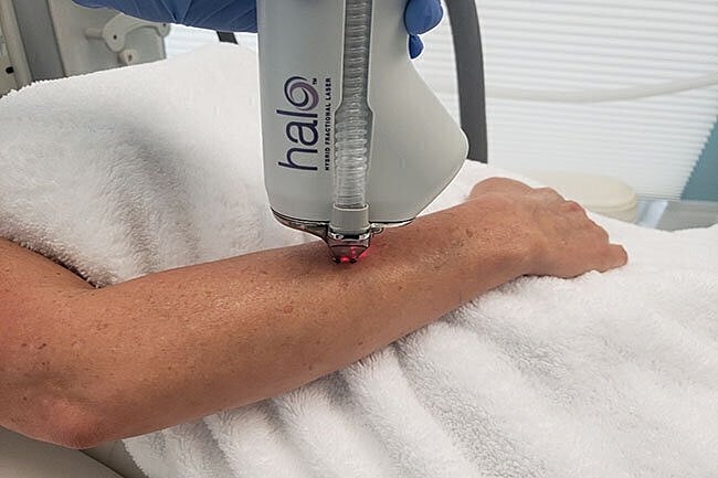Laser treatment on a patient's arm.