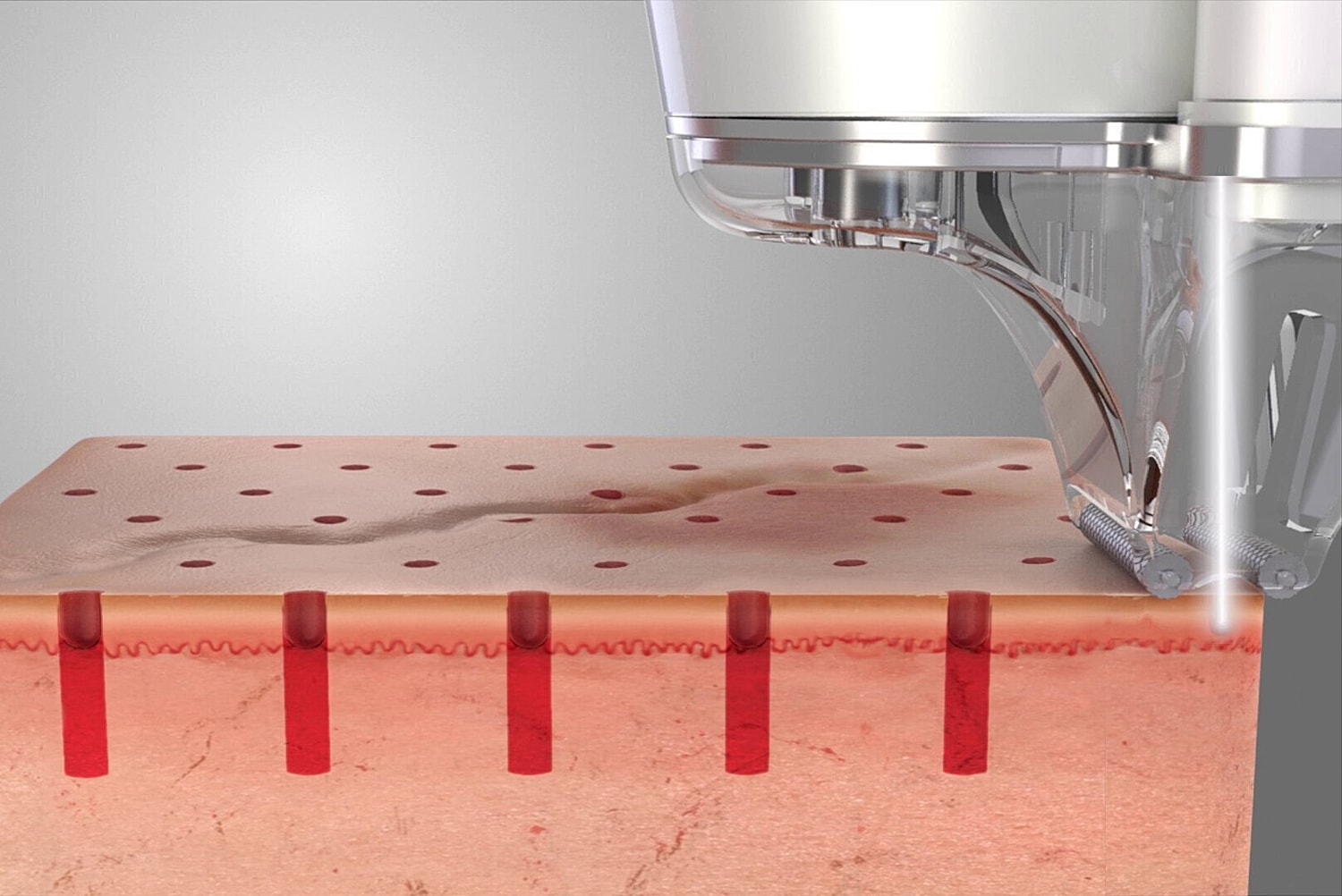 Skin treatment device with laser-like technology.