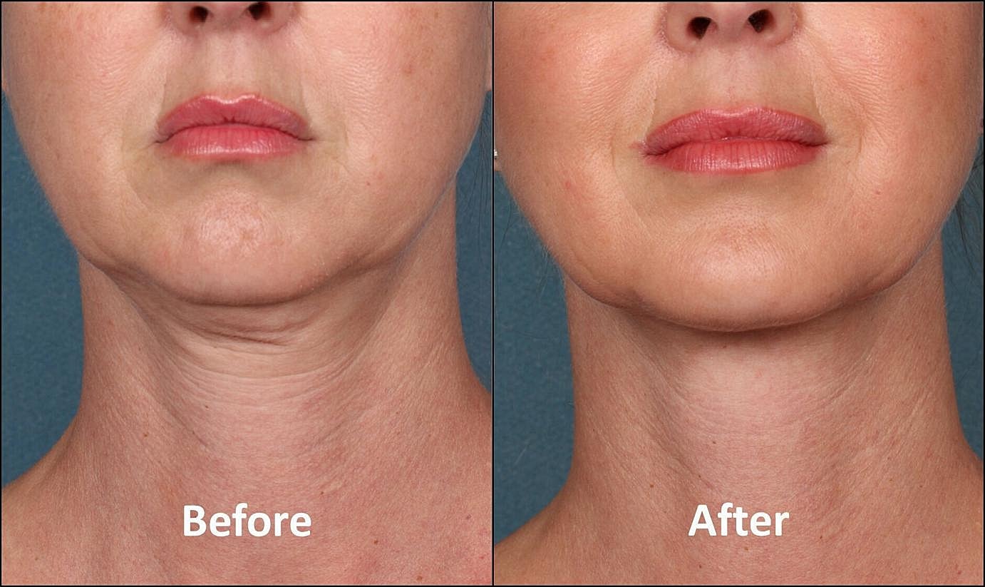Before and after neck treatment comparison.