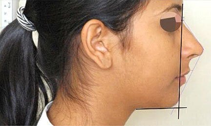 Profile view of a woman with measurement lines.