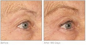 Before and after eye treatment comparison image.