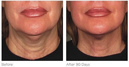 Before and after skin improvement results.