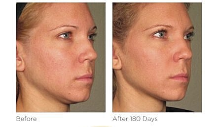 Facial improvement: before and after treatment comparison.