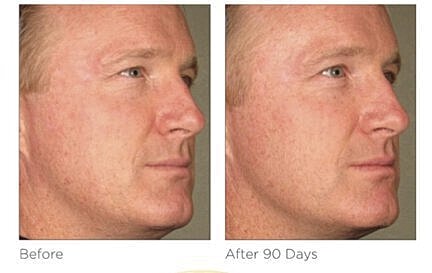 Before and after facial treatment results comparison.