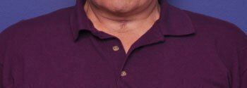 neck lift for men before & after photo