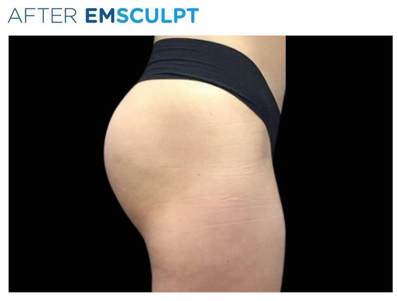Before & After Athletic Gluteal Augmentation in Vero Beach