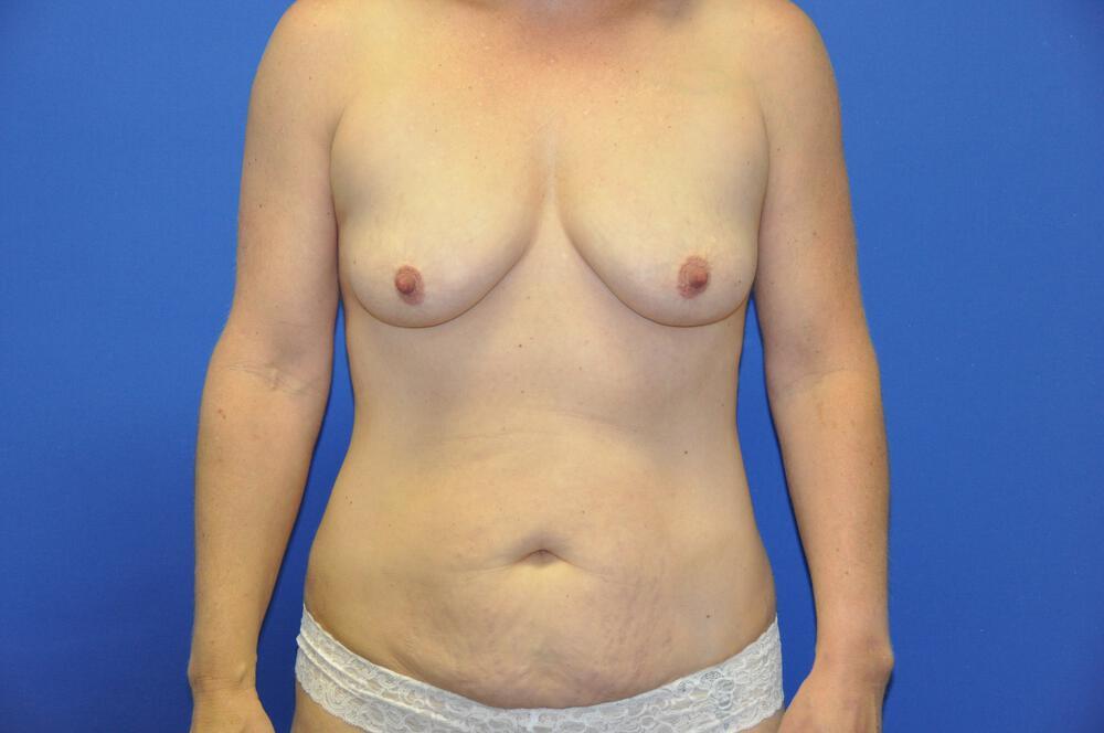 Mini Abdominoplasty Gallery Before & After Image