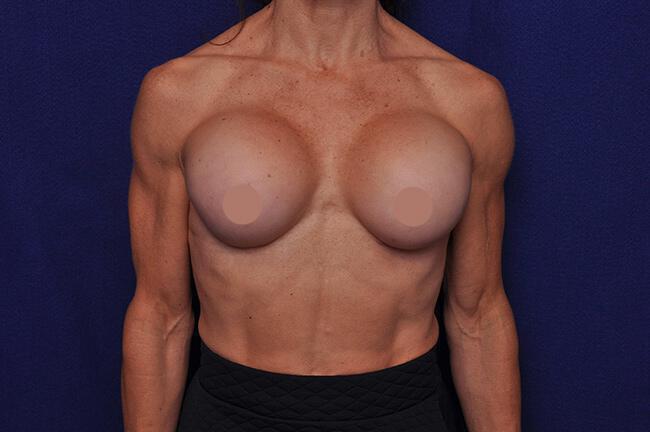 Breast Augmentation Revision in Athletes