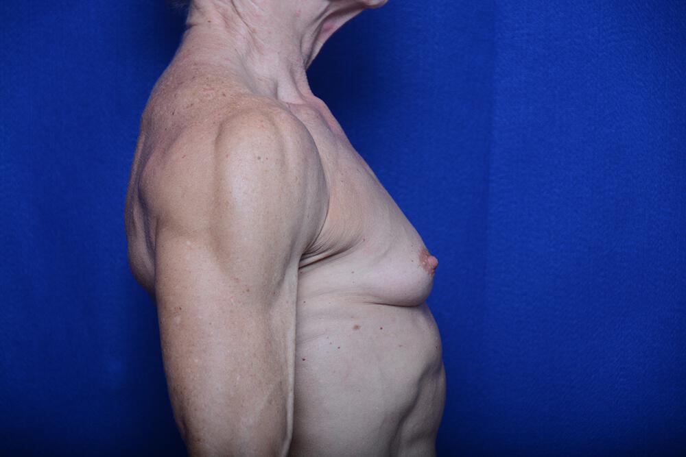 Athletic Breast Augmentation Gallery Before & After 07